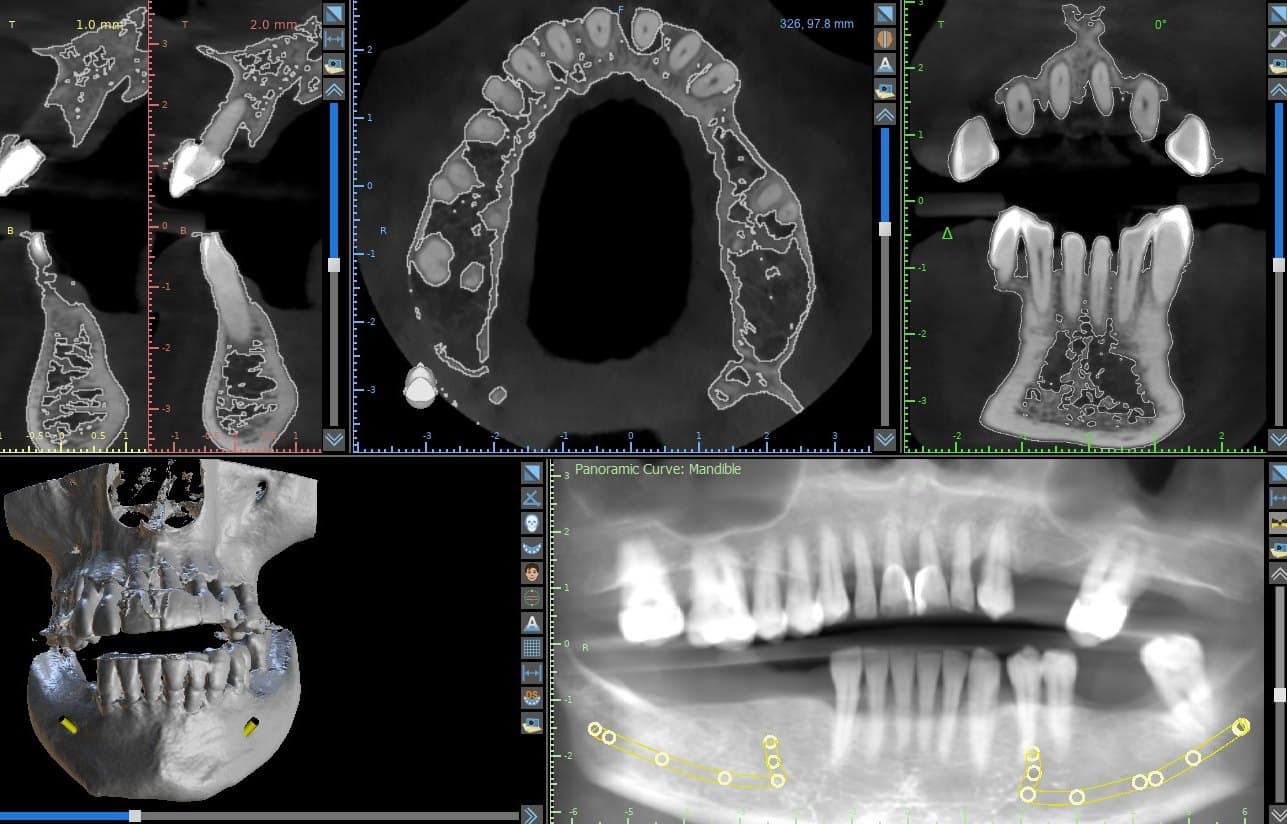 CBCT cross-sections, axial slice, 3D reconstruction and panoramic curve of the mandible with the nerve canal traced, before implant planning