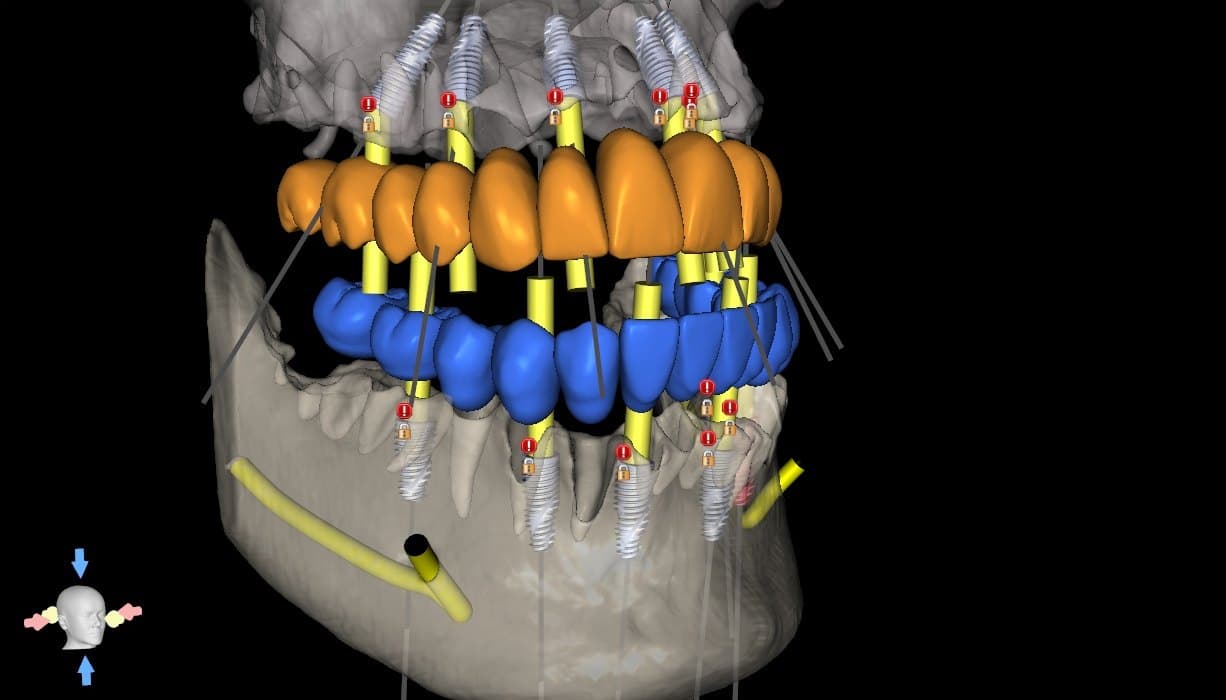 Full-arch plan verification: upper and lower prosthetic set-ups with planned implant positions and trajectories