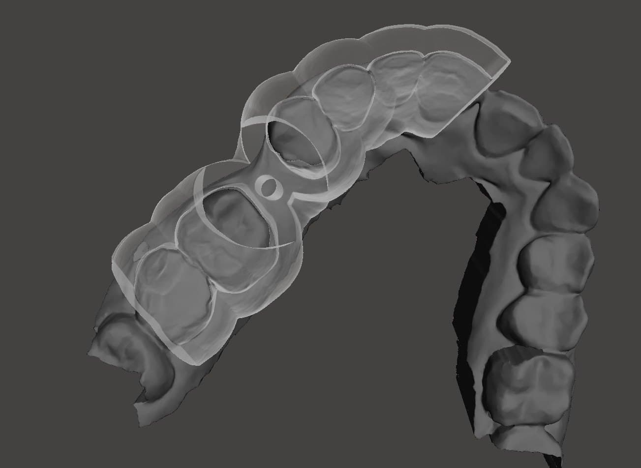 Surgical guide body shown over the dental scan to assess how the guide is supported on the teeth before release