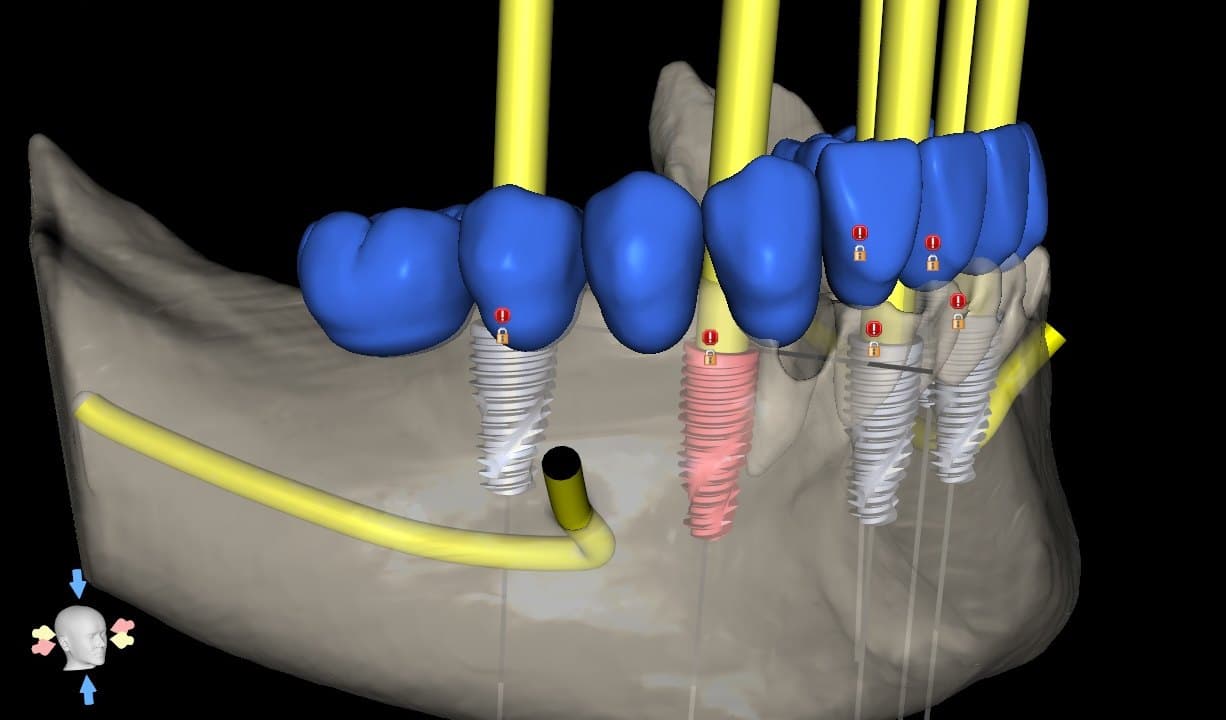 3D planning view of the mandible with planned implants, the prosthetic tooth set-up and the traced nerve canal