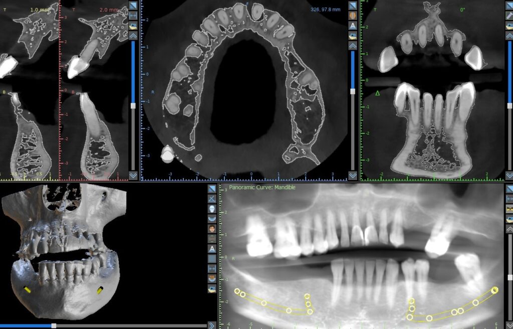 CBCT cross-sections, axial slice, 3D reconstruction and panoramic curve of the mandible with the nerve canal traced, before implant planning