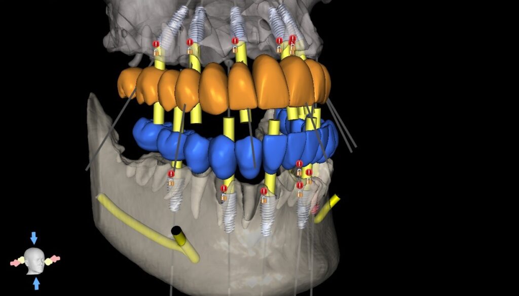 Full-arch plan verification: upper and lower prosthetic set-ups with planned implant positions and trajectories