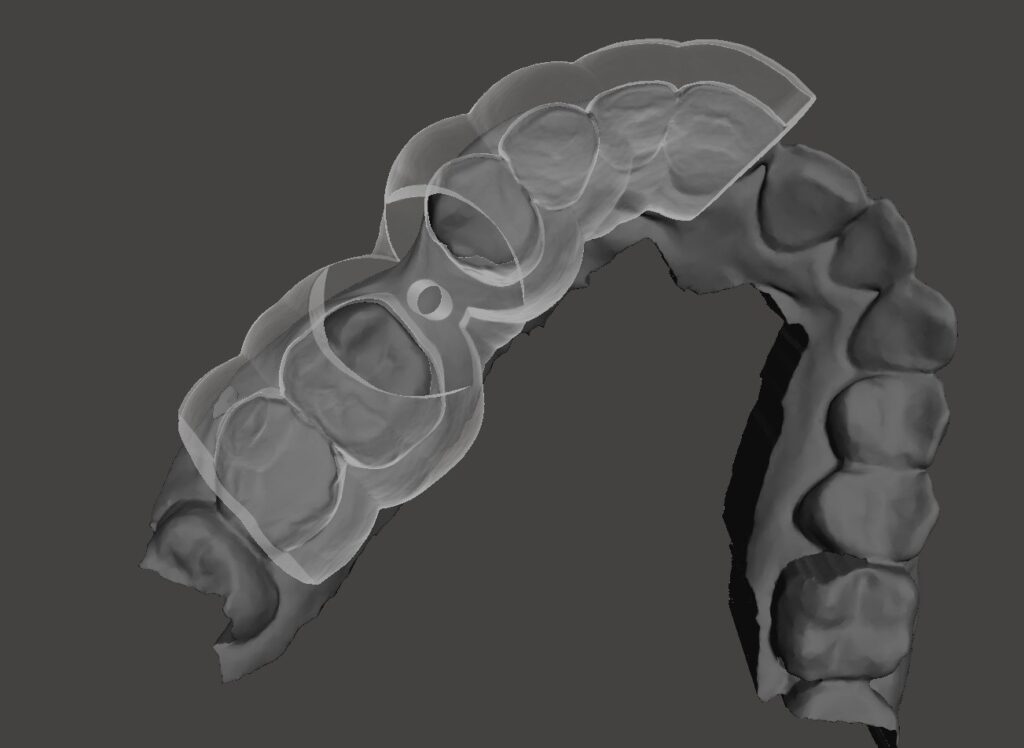 Surgical guide body shown over the dental scan to assess how the guide is supported on the teeth before release