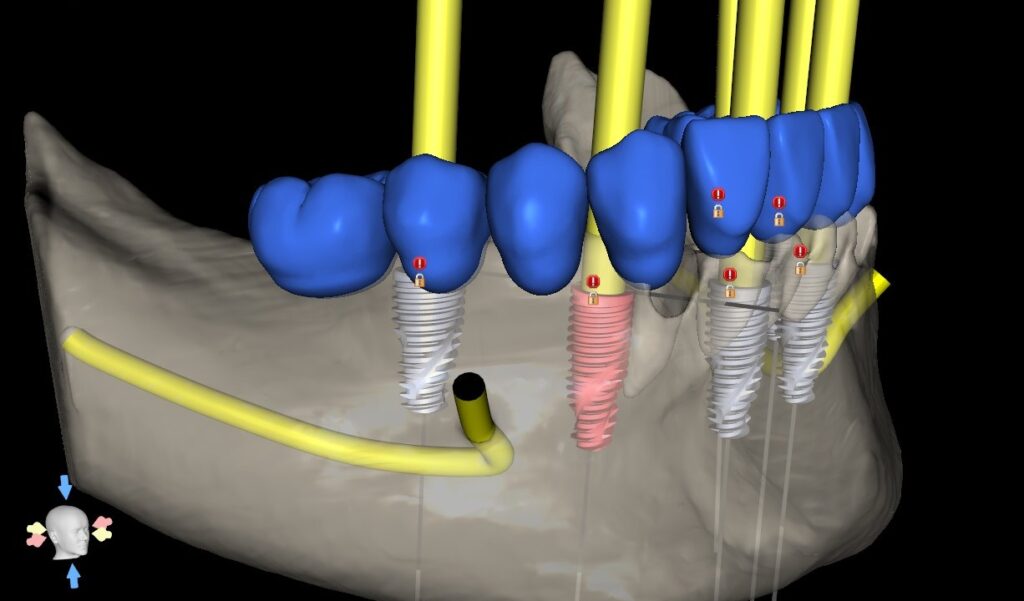 3D planning view of the mandible with planned implants, the prosthetic tooth set-up and the traced nerve canal