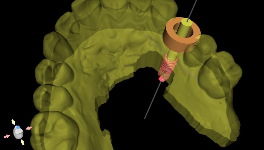 Planning view checking a guide sleeve and the drill path of a planned implant before the guide is released