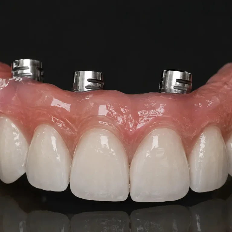 Dental Implant Prosthesis